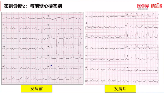 易漏诊,误诊的肺栓塞心电图特点