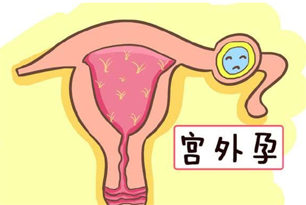 为什么通过试管婴儿移植还出现了宫外孕呢?