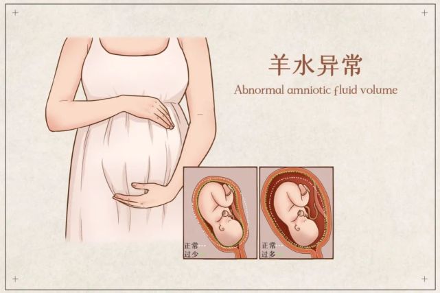 "羊水过少,喝水来凑—靠谱吗?