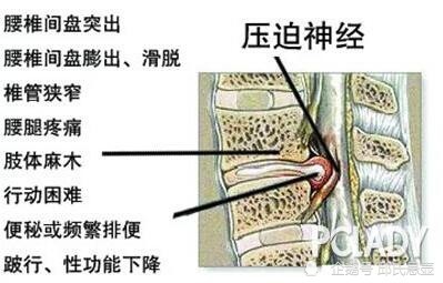 慢性期腰椎间盘突出的锻炼方法三种?邱氏悬壶