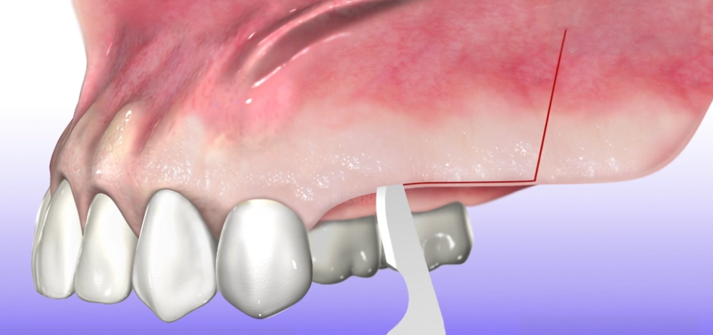 不爱护牙齿的后果,根管治疗和种牙手术