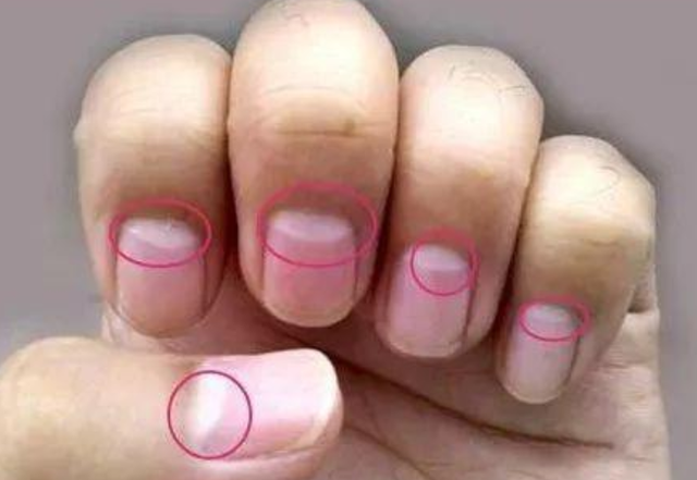 一般来说正常人会有8~10个半月痕,约占指甲的1/5,有一些人的小指也会