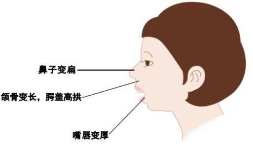 所以张嘴呼吸导致的比较丑陋的面容被称为腺样体面容,通常是因为人腺