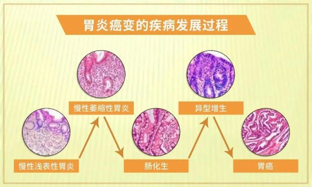 慢性萎缩性胃炎就是胃变小了吗严重吗