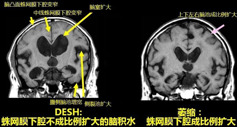 3;在冠状层面显示:侧裂池以上及中线两侧脑沟及蛛网膜下腔变窄,多见于