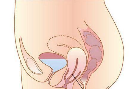 女人患子宫脱垂后的两种改善方法