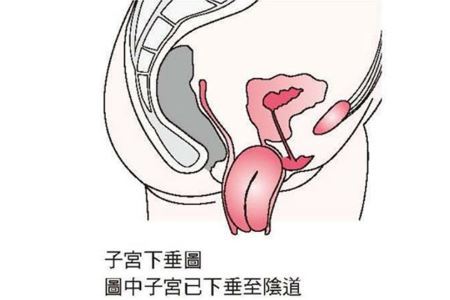 女人患子宫脱垂后的两种改善方法