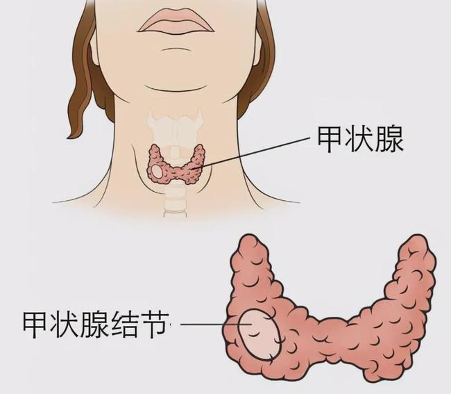 发现甲状腺结节钙化该怎么办?