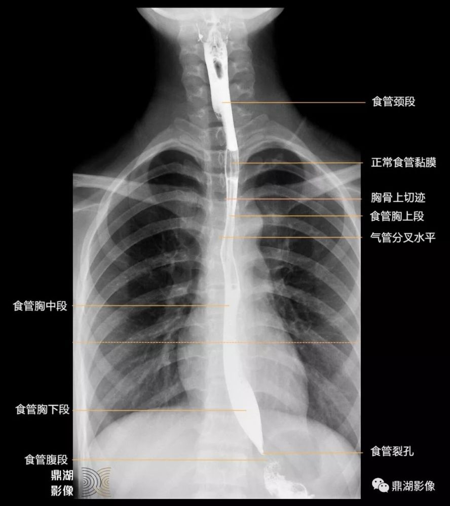 x线高清图谱|食管造影解剖