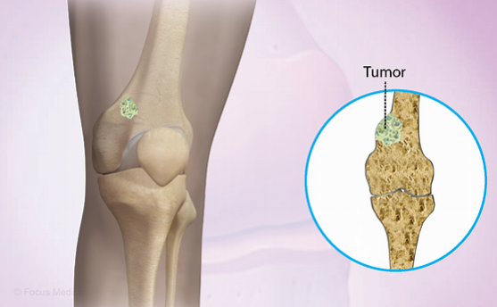 最常见的肉瘤类型是骨肉瘤,在骨骼中发生变异之后未成熟的骨骼细胞