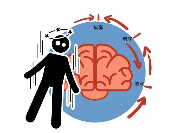 在临床上脑梗的早期表现多种多样,防不胜防.