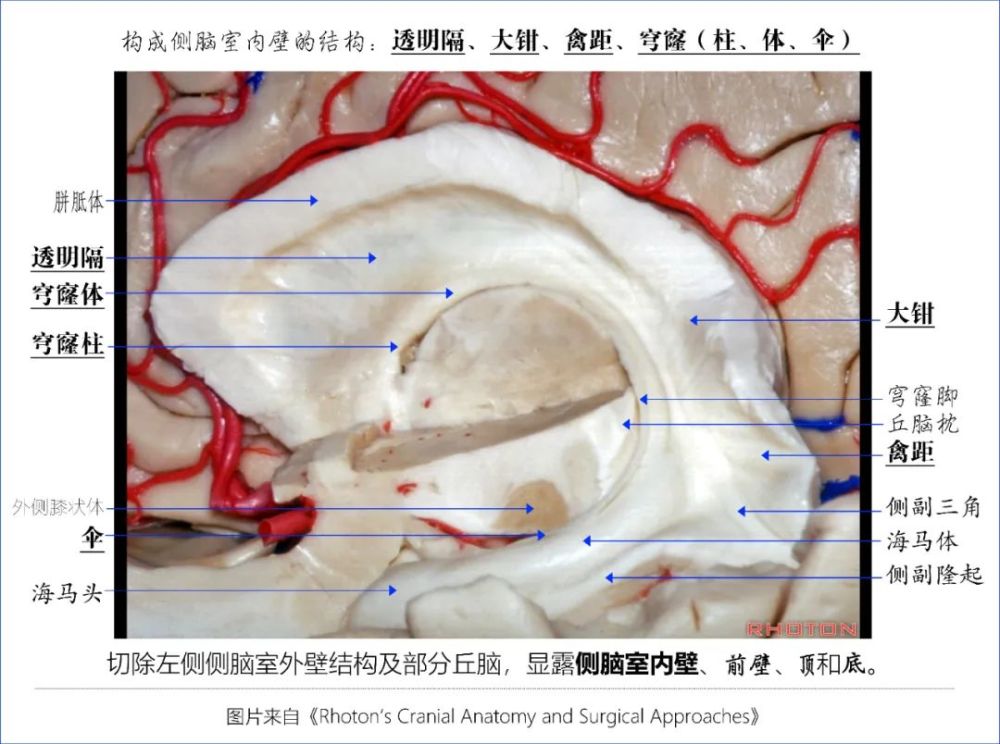 (6)禽距(calcar avis)侧脑室枕角内壁侧脑室房部内壁胼胝体压部的纤维