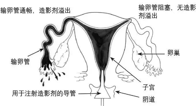 输卵管造影是一种侵入性的手术操作,在扩张阴道,阴道宫颈消毒,插管时