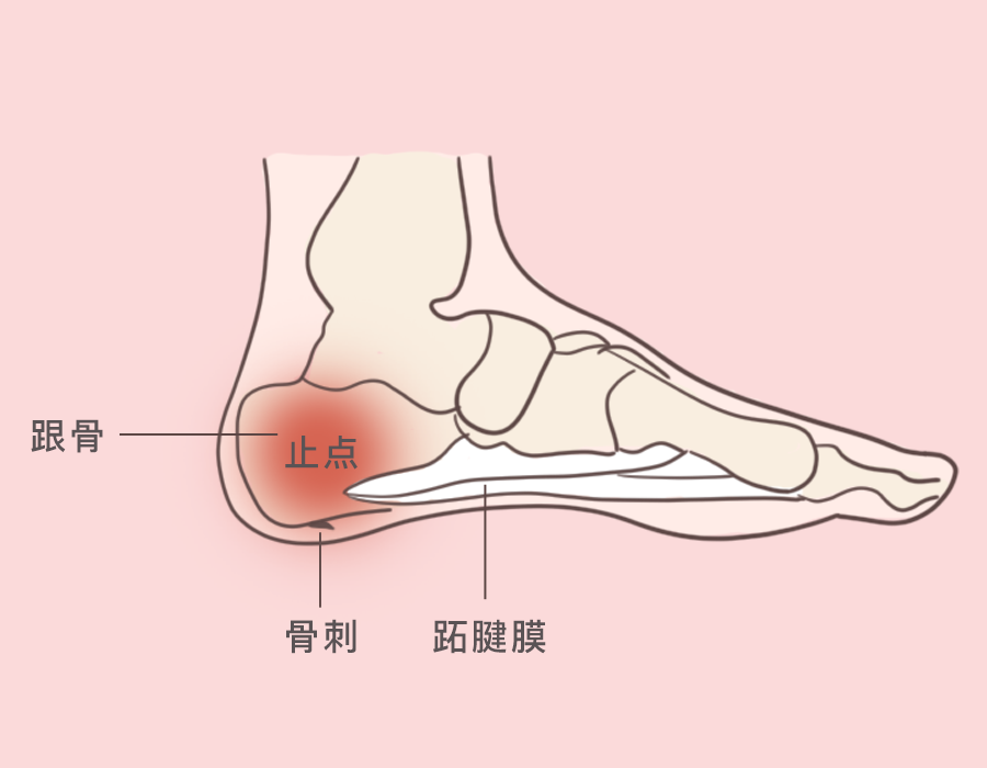 总是脚后跟疼不能走路跑步医生说是这个病