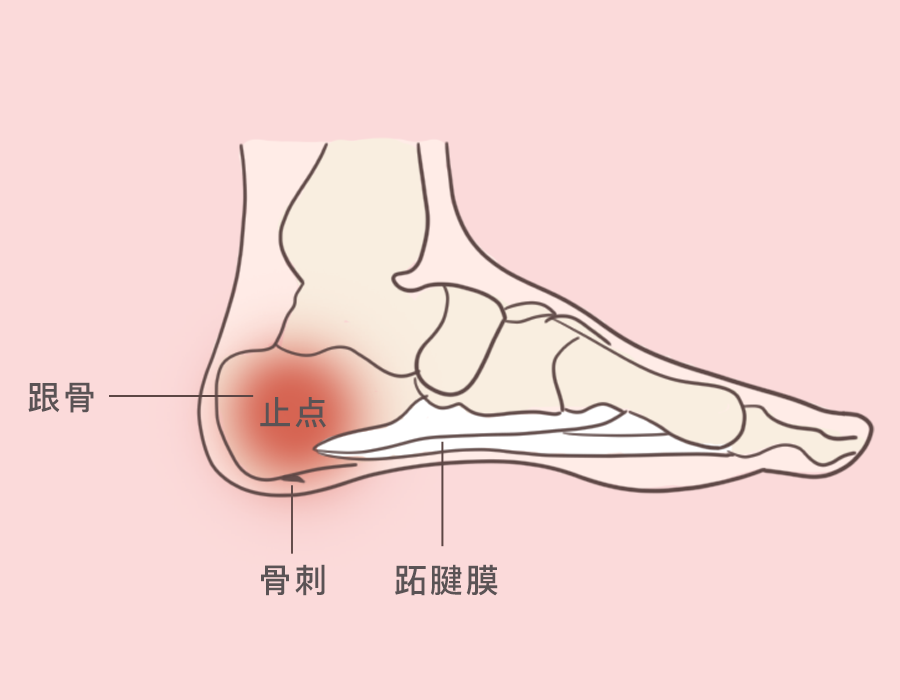 跖腱膜是足底很坚韧的纤维束结构,起于近节趾骨跖侧,止于跟骨结节内侧