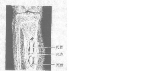 附骨疽是何病乾隆最宠爱的永琪因此而死满清皇室多患此病