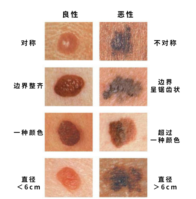 人各有痣不可轻视