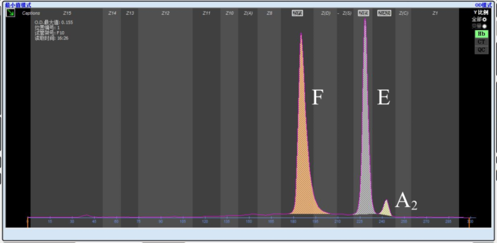 2.血红蛋白电泳分析:hbf55.9,hb3.