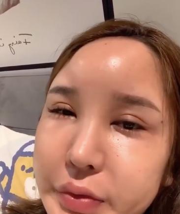 网红桃花宝宝多次整容额头鼓起疼到睡不着自曝被医院拒收