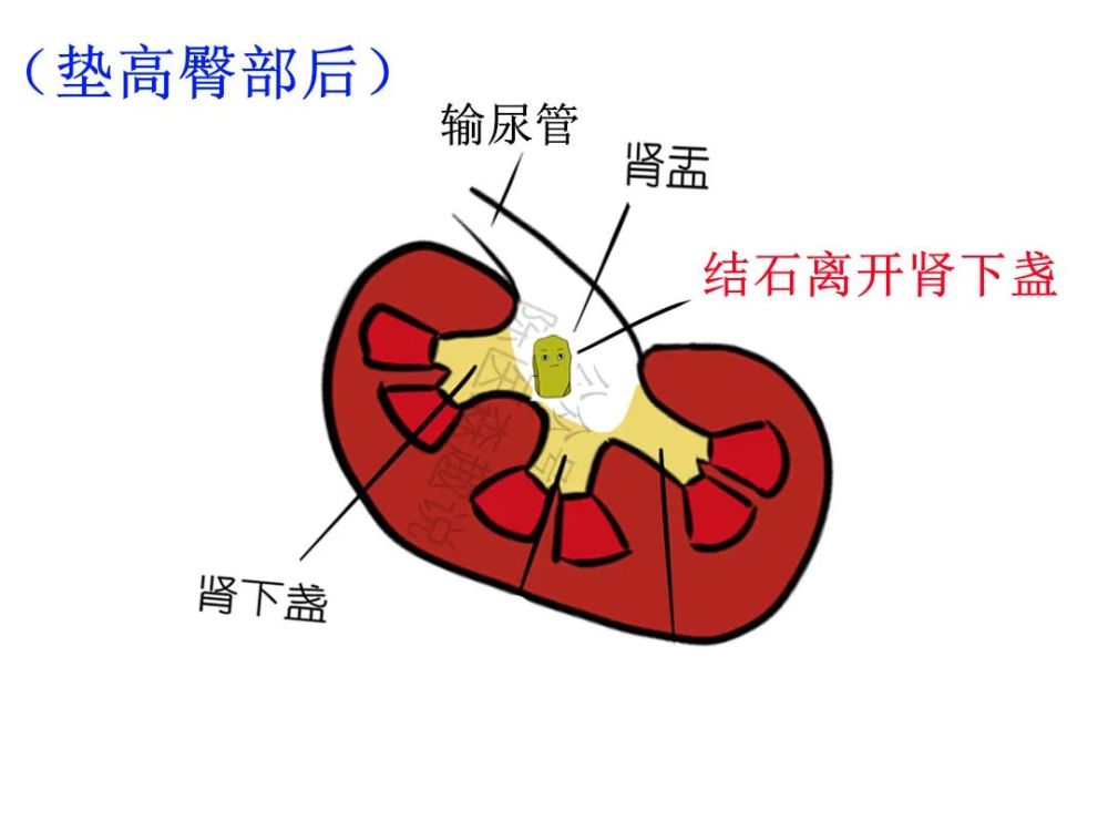 肾下盏的结石很难排出?一定要试试这个方法