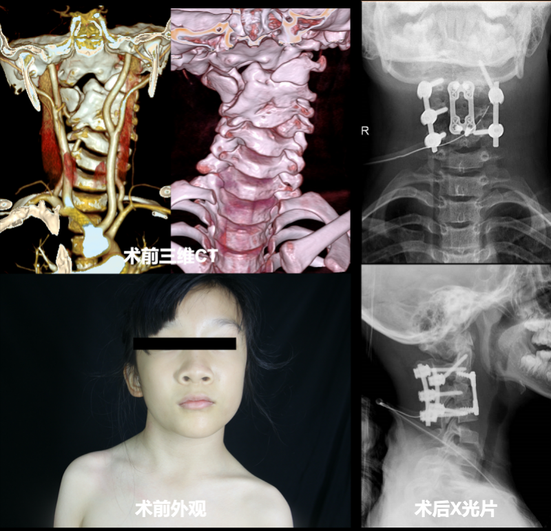 女孩颈椎畸形歪脖子,跨国商讨方案后广州医生帮其"正颈"