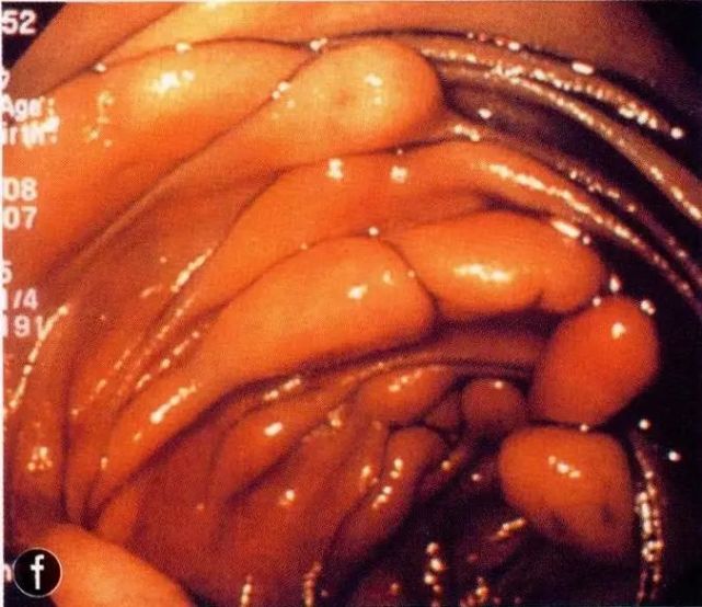 小肠脂肪瘤