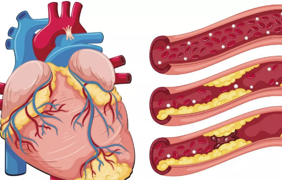 得了冠心病还能活多久?医生道出真相:做好这三点是关键