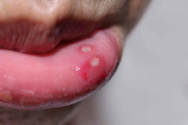 口腔溃疡久治不愈,警惕是口腔癌的信号,还有5个异常