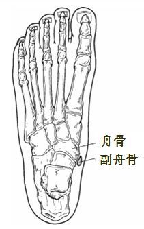 5a骨髓水肿(圆圈)及5b胫后肌腱水肿(箭)对于有症状的副舟骨,保守治疗