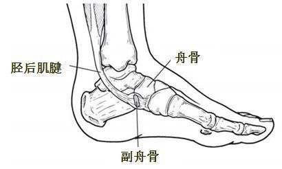 的解剖学变异,其发生是由于舟骨近距侧或舟距关节间出现一个骨化中心