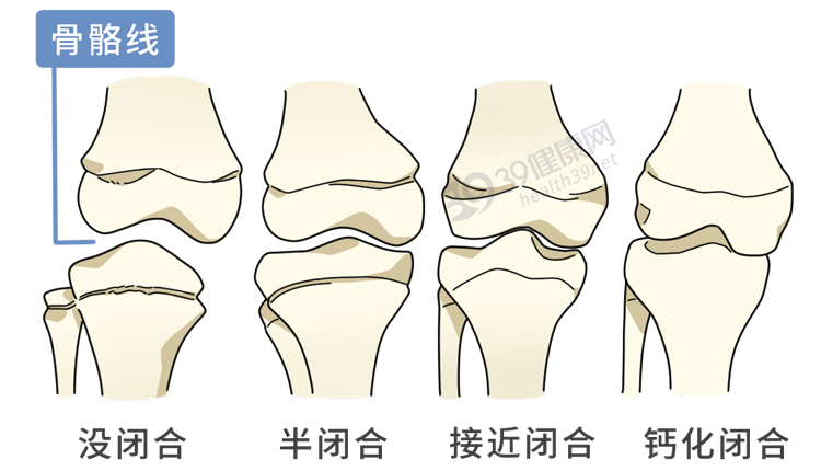 骨骼线有没有闭合 也是长高重要因素之一