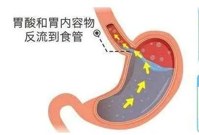 反流性食管炎的成因是什么?会出现哪些症状?