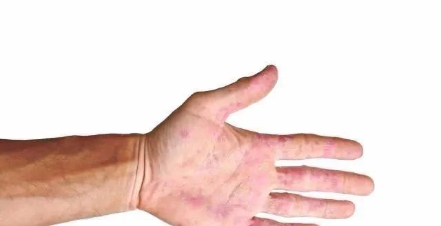肝病都是拖出来的,一旦晨起有4个表现,是肝在"求救",别大意