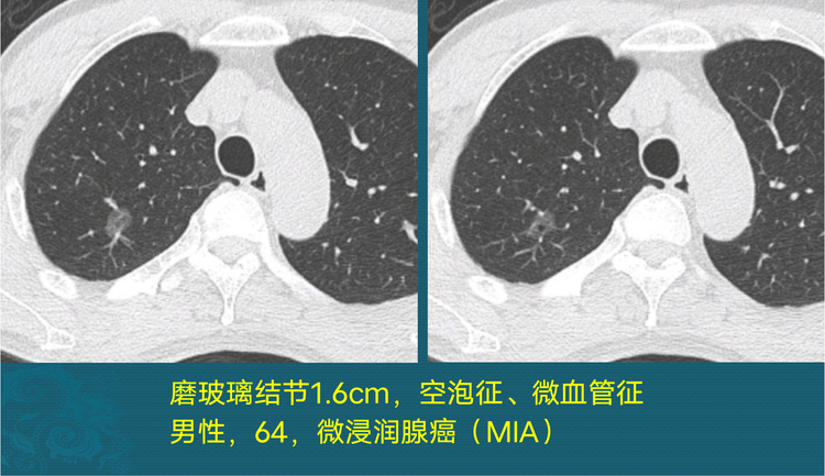 肺结节与肺癌怎么区分?医生教你看ct,认识3种恶性肺结节
