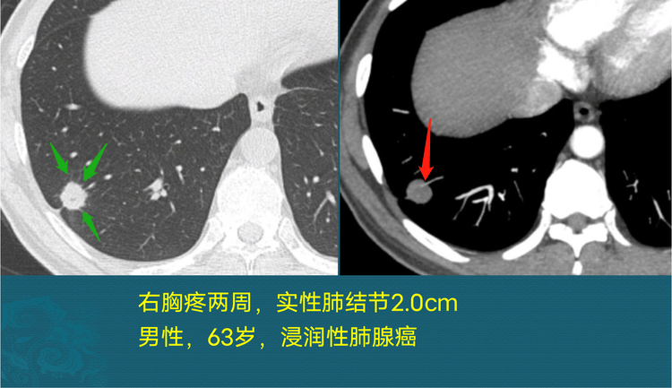 肺结节与肺癌怎么区分?医生教你看ct,认识3种恶性肺结节