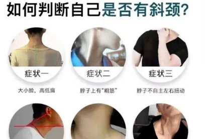 痉挛性斜颈是的病因原来是它们?