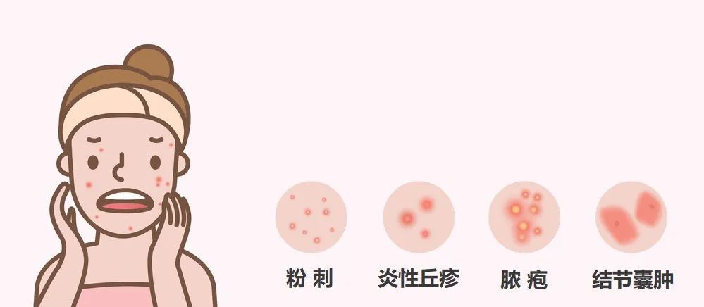 如何正确祛痘:先搞清楚你的痘痘是哪种类型