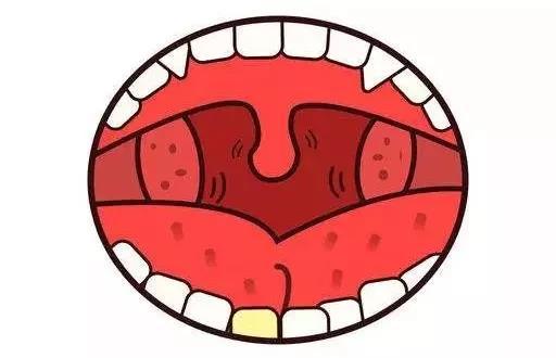 生命汇整合医疗|孩子扁桃容易发炎怎么办?
