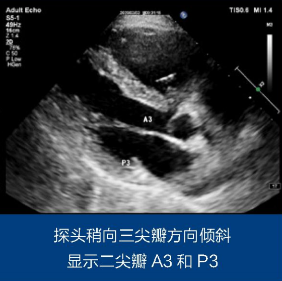 二尖瓣解剖分区及常用超声扫查切面