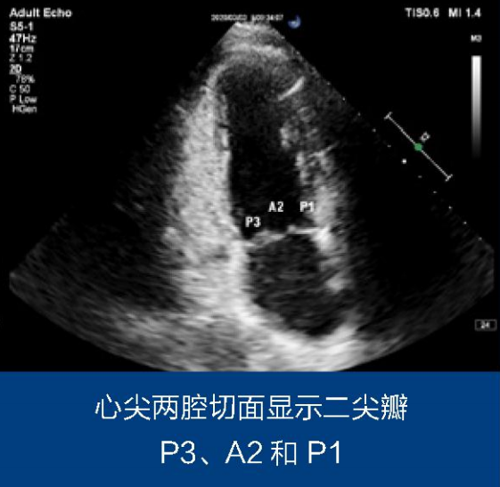 二尖瓣解剖分区及常用超声扫查切面