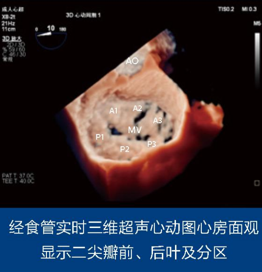 二尖瓣解剖分区及常用超声扫查切面