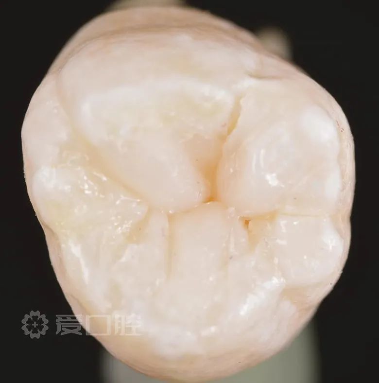 补牙也是门艺术!上颌第二颗磨牙树脂分层充填欣赏