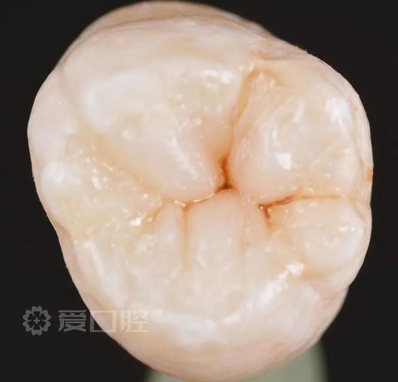 补牙也是门艺术!上颌第二颗磨牙树脂分层充填欣赏