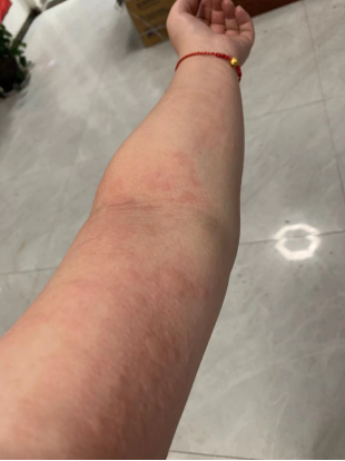 午间休息,医务人员充当人肉衣架,在太阳底下晾晒被汗水浸湿的衣服.