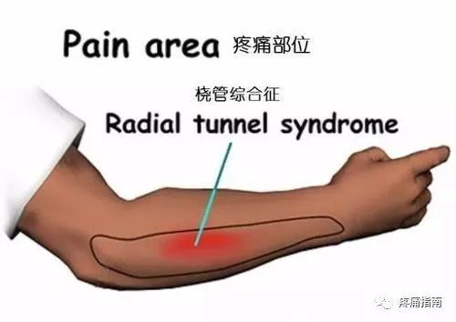 6,肘部尺管综合征这是尺神经在肘部尺管组成的骨纤维通道内受卡压所致