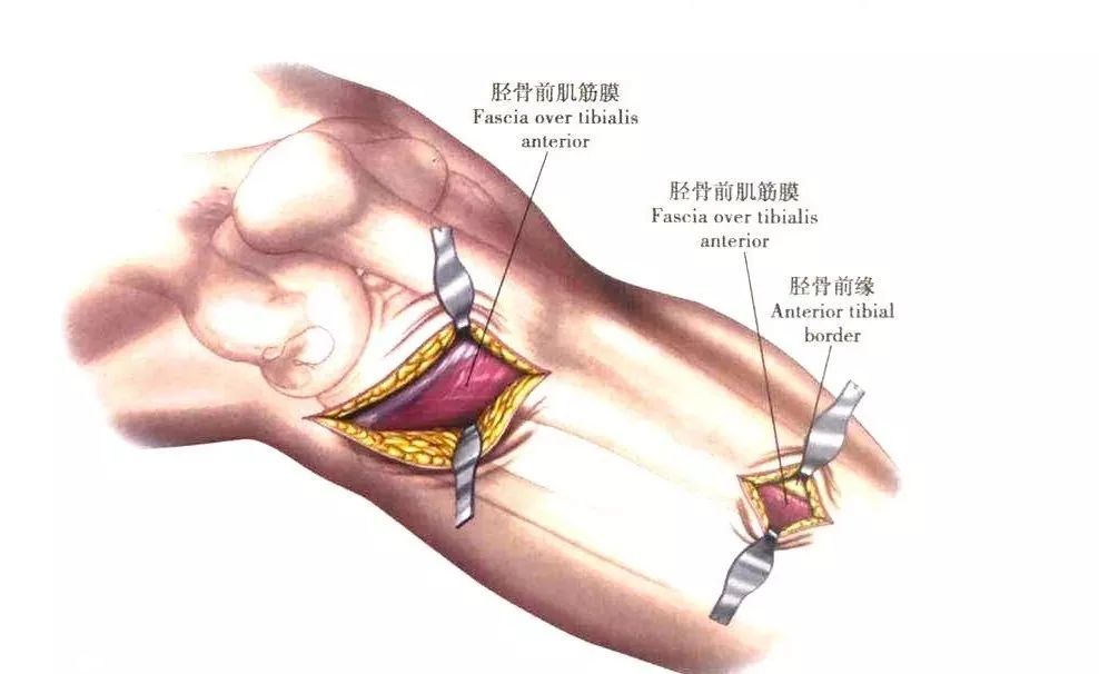 骨科精读详解胫骨骨折的七种手术入路图文结合轻松掌握