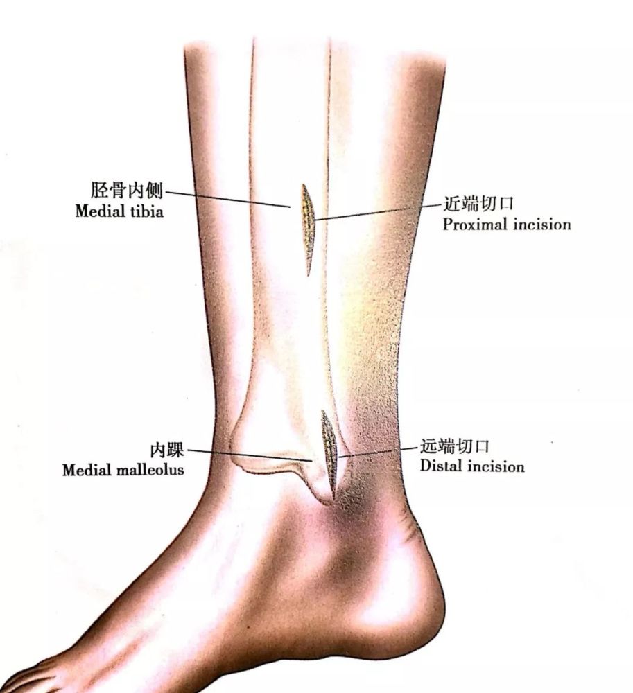 图9 在远端,做一长约3～4cm的切口,起自内踝远端,并在胫骨前后缘之间