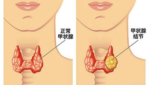 云南中西医结合医院甲状腺专科:甲状腺结节到底是什么