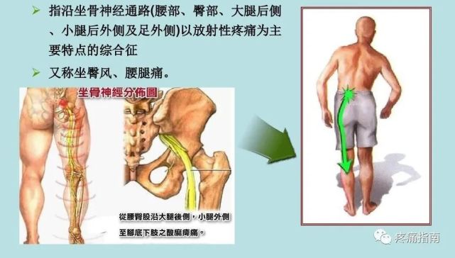 坐骨神经痛与腰椎间盘突出