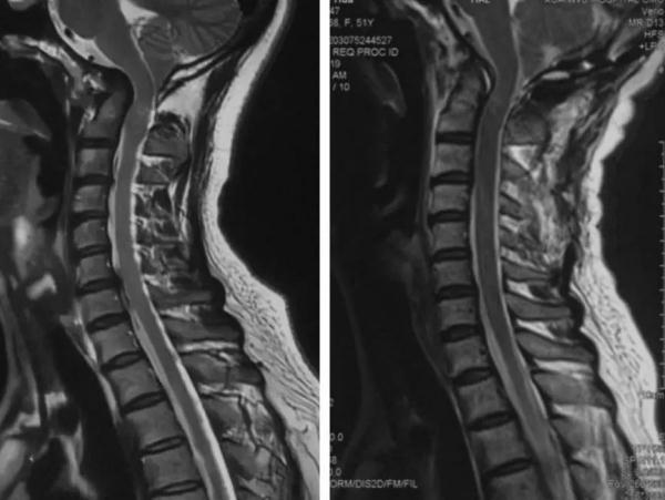 颈椎的核磁共振片 事前检查不容小觑: 按摩手法是需要借助医者的力量